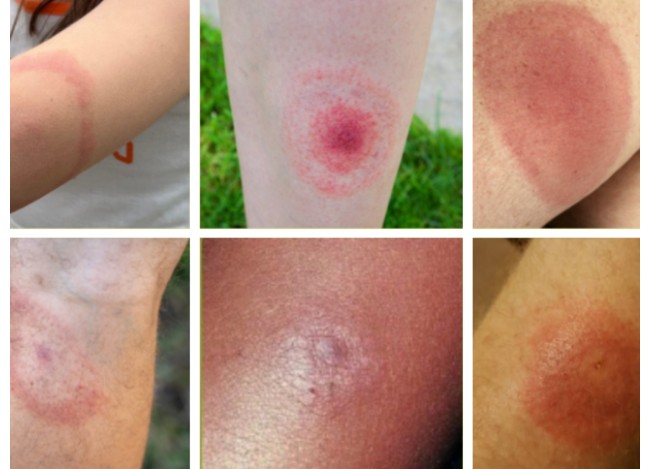 Tick Bite Prevention and Lyme Disease Awareness 